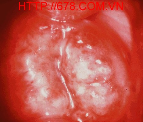 Bệnh herpes cổ tử cung